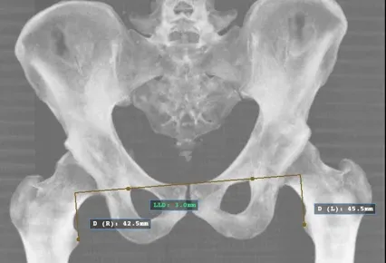 Crooked butt xray