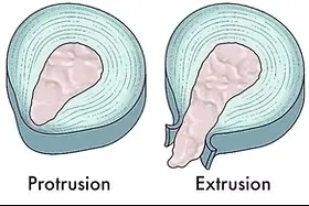 Disc extrusion treatment in boston can you avoid back surgery