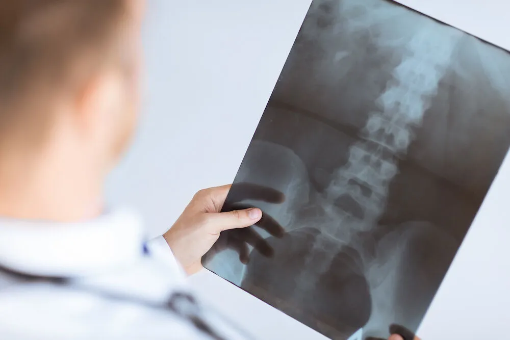 Spine x ray imaging