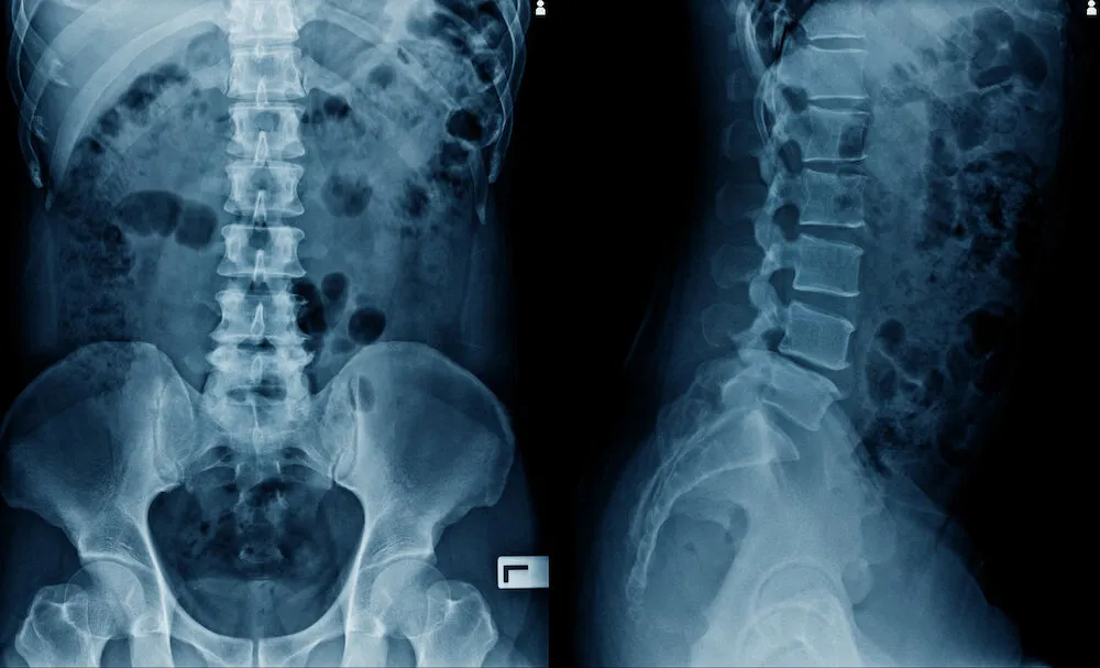 Spine x ray